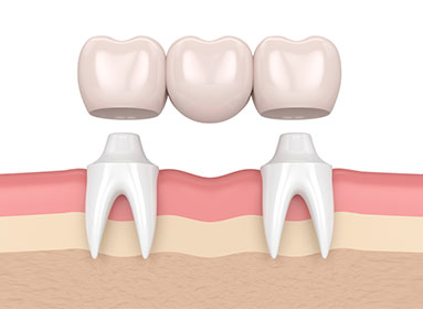 پروتز-ثابت-دندان